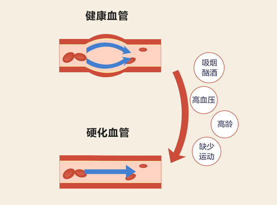 血管弹性与健康 血管弹性与健康