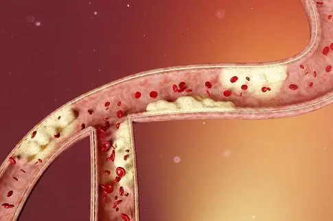 血管弹性与健康 血管弹性与健康