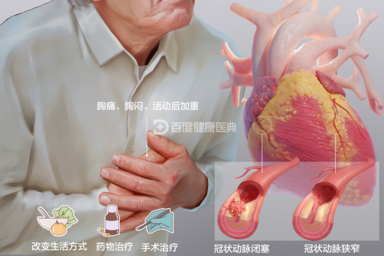 慢性病你关注过吗 慢性病你关注过吗