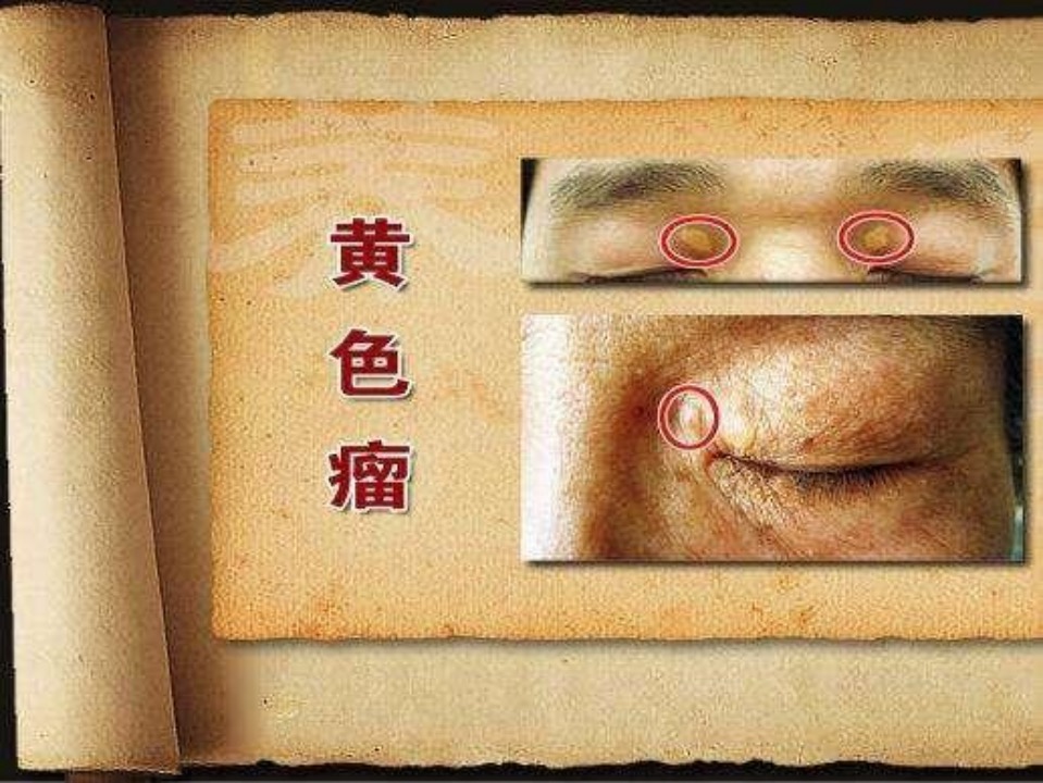 慢病表现形式,您清楚吗?(三) 慢病表现形式,您清楚吗?(三)