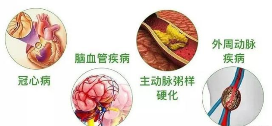 血管健康的意义（二）