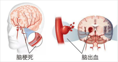 血管的病变对健康的影响(一) 血管的病变对健康的影响(一)